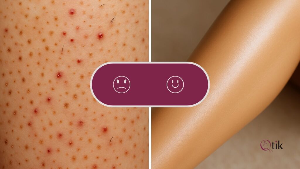 اپیلاسیون در خانه